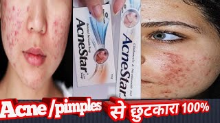 acne treatmentacnestar gelsoap pimples ka ilaajpimples ki dawaclin3 gelpersol ac 25 [upl. by Harms]