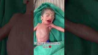 Extremely low birth weight baby born with 950garm ankur maitrika hospital 🏥♥️ [upl. by Yanej]