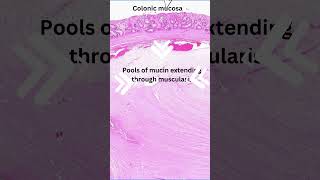 Histology of colitis cystica profunda [upl. by Bithia499]