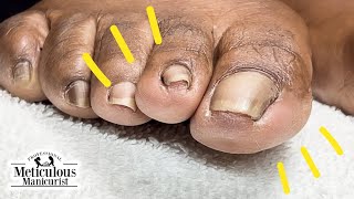 How to Fix Toenail Discomfort [upl. by Ellehcer]