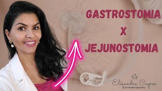 GASTROSTOMIA E JEJUNOSTOMIA VOCÊ SABE QUAL É A DIFERENÇA [upl. by Apple]