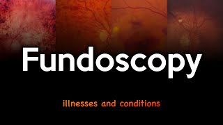 Fundoscopy Illnesses and Conditions [upl. by Einattirb801]