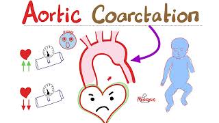 Coarctation of the Aorta  Cardiology Series  Types Symptoms Signs Diagnosis amp Treatment [upl. by Muna]