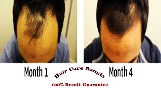 Homeopathic Medicine For Alopecia and Baldness  Hair Care Bangla [upl. by Dnomaid]