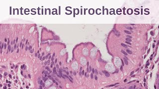 Intestinal Spirochaetosis  Pathology mini tutorial [upl. by Ferdinande]