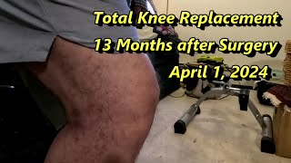 Total Knee Replacement  13 Months After Surgery  April 1 2024 [upl. by Garrity]