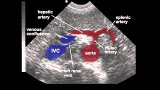 Abdominal Aortic Aneurysm AAA Ultrasound [upl. by Carolee711]