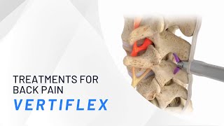 The Vertiflex Procedure  Treatments for Back Pain [upl. by Avehs597]