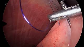 Laparoscopic Feeding Jejunostomy [upl. by Jard]