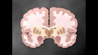 Parkinsons part 1 of 2  Medical Animation by Watermark [upl. by Anoi]