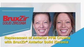 Replacement of Anterior PFM Crowns with BruxZir Anterior Solid Zirconia Crowns [upl. by Nnyleahs]