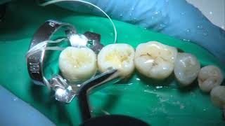 OPERATORIA DENTAL Y ENDODONCIA TÉCNICAS Y MATERIALES7 COMPOSITE CAVIDAD DE CLASE I [upl. by Dawna]