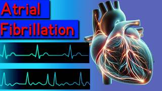 Atrial fibrillation symptoms causes risks and treatment [upl. by Enelrac]