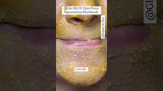 😱Get Rid Of Open Pores Pigmentation Blackheads shorts [upl. by Nnahteb]