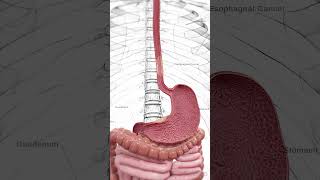 🔬 Understanding Esophageal Cancer Early Detection Is Key 🔬 anatomy [upl. by Sukramal]