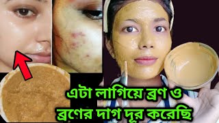 ব্রণ থেকে মুক্তি পাবে 1 দিনে 100  গ্যারান্টি  bron dur korar upay  How To Remove Acne Pimple [upl. by Enenstein262]