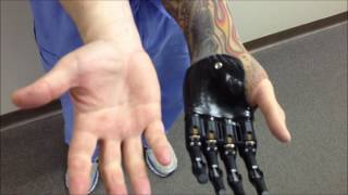 Idigits from Touch Bionics [upl. by Barbur968]