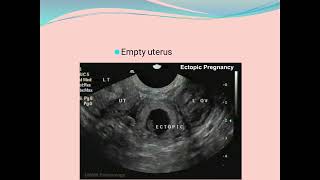 Bleeding in early pregnancy part 2Ectopic pregnancy [upl. by Haletta]