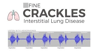 Fine Velcro Crackles [upl. by Hooke]