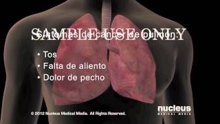 Síntomas del cáncer de pulmón [upl. by Sauncho]