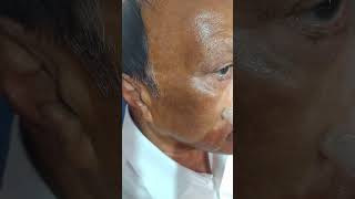 Pigmentation Melasma Remove Treatment by Dermapen PRP [upl. by Guthrey]