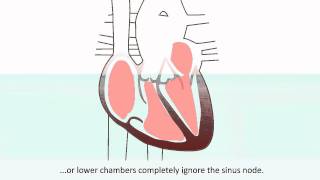 Arrhythmias  What is an arrhythmia and what treatments does it require [upl. by Areem]