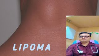 LIPOMA kya hota hai Lipoma symptoms [upl. by Terzas]