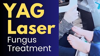 YAG Laser Treatment for Toenail Fungus Nd YAG Laser Before and After [upl. by Craw]