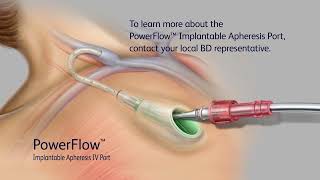 PowerFlow Implantable Apheresis IV Port Access Video [upl. by Boyse251]