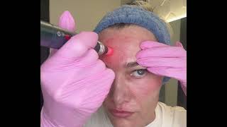 Microneedling Technique  Forehead [upl. by Gillespie]