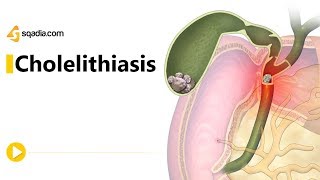 Gallstone Disease  Acute Cholecystitis vs Cholelithiasis vs Choledocholithiasis vs Cholangitis [upl. by Anaid]