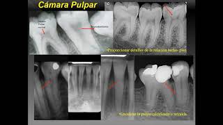 técnicas radiográficas en endodoncia [upl. by Alena]