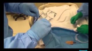 Percutaneous Endoscopic Gastrostomy pull method and Jejunal Extension Tube Placement [upl. by Eidualc]