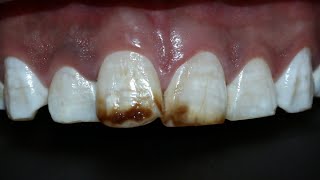 Tratamiento fluorosis dental  antivet [upl. by O'Doneven]