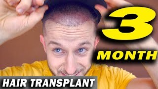 FUE Hair Transplant 3 Months post op Istanbul Turkey [upl. by Keyek919]