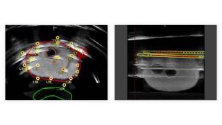 Realtime Prostate Solutions for treating prostate cancer with brachytherapy [upl. by Euqnom270]