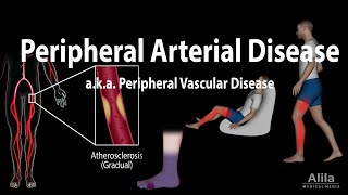 Peripheral artery disease Pathophysiology Causes Symptoms Diagnosis and Treatments Animation [upl. by Mussman]