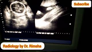 Anterior placenta and baby boyGender prediction on ultrasound Baby boy on ultrasound [upl. by Erena399]