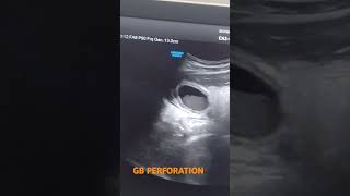 G B PERFORATION usg radiodiagnosis [upl. by Hulburt]