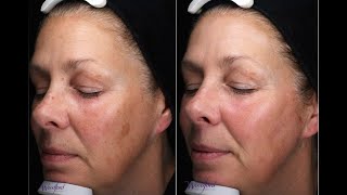 BBLMoxi Laser treatment at Woodford Medical  real patient review [upl. by Savanna]