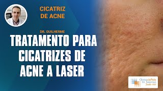 Cicatrizes de Acne Laser de CO2 Fracionado DEKA [upl. by Fabozzi491]