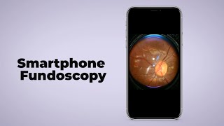 Smartphone Fundoscopy turn any smartphone into fundus camera [upl. by Lela]