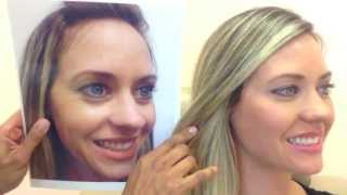 Botox amp Restylane Before amp After [upl. by Anisah]