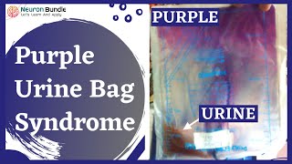 Purple Urine Bag Syndrome  Aetiology management urinediscolouration uti medschool [upl. by Weinstein]