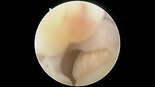 Cervical and uterine polyp with Ashermans adhesions [upl. by Glarum]