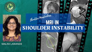 MRI IN SHOULDER INSTABILITY  MALINI LAWANDE  Hill Sachs  Bankart  Labral Tear  ALPSA  HAGL [upl. by Osicran108]