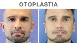 Otoplastia antes y después  Testimonio de David [upl. by Ocirred]