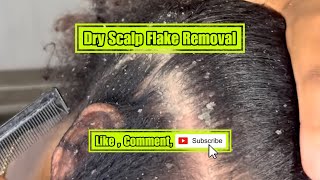 Dry scalp Flake removal [upl. by Gelasius458]