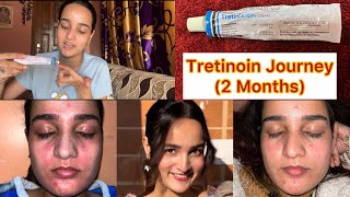 2 Month RetinolTretinoin Journey✨ [upl. by Braunstein421]