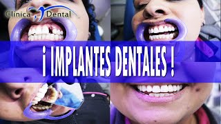 IMPLANTES DENTALES ANTES Y DESPUÉS [upl. by Rehpotsihc774]